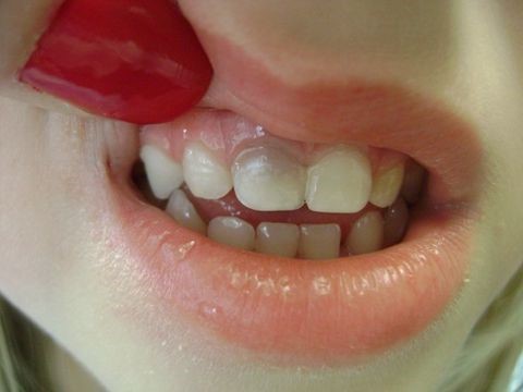 دندان کودک شما چه رنگی شده ؟ هر رنگ علتی دارد