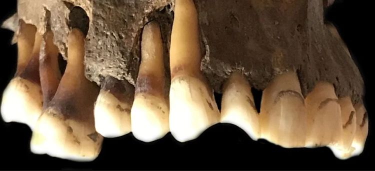 دندان انسان باستان