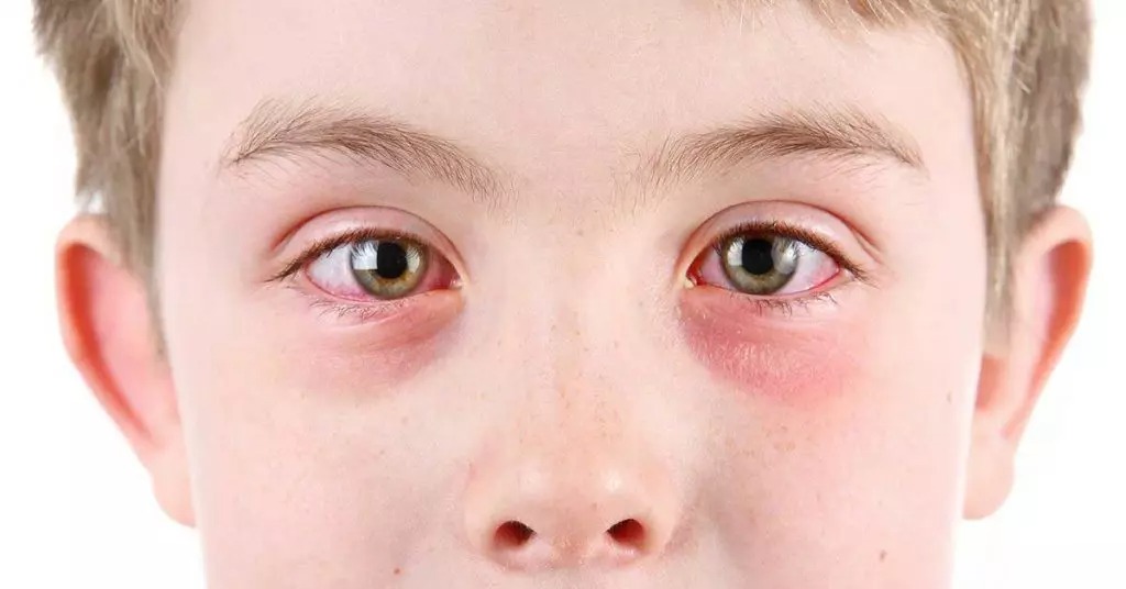 ضعیف شدن چشم ها - نزدیک بینی - عارضه بینایی
