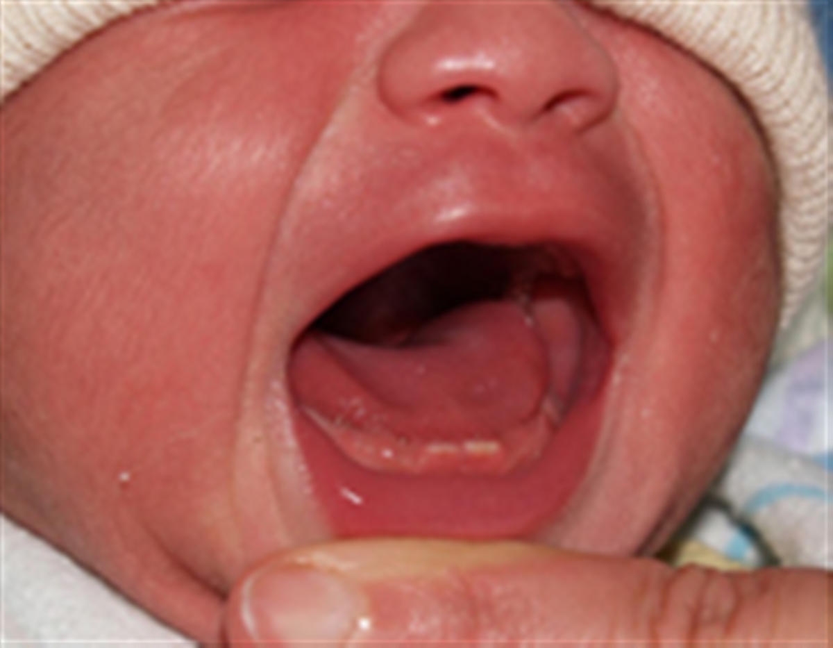  علل تولد نوزاد با دندان و انواع دندان های ناتل + مشکلات