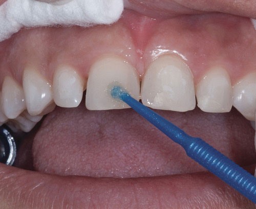 تفاوت نسل باندینگ های دندانپزشکی در چیست؟